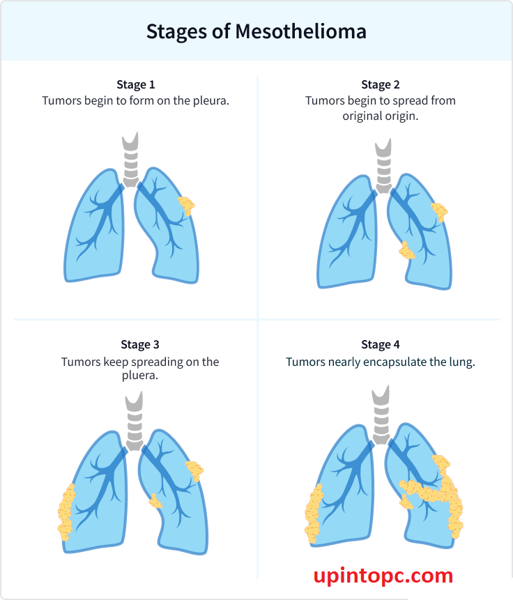Mesothelioma Stages