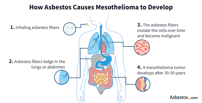 Mesothelioma Causes