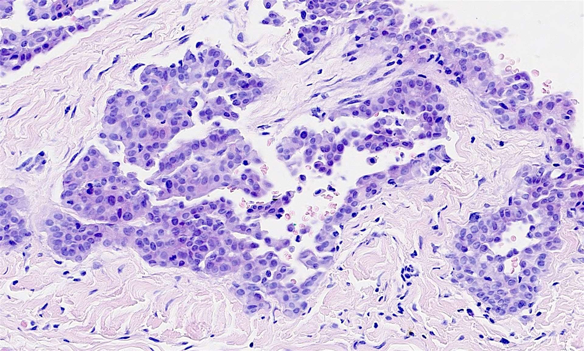 Mesothelioma Pathology Outlines