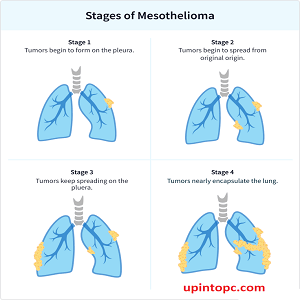 Mesothelioma Stages: Understanding the Progression of the Disease